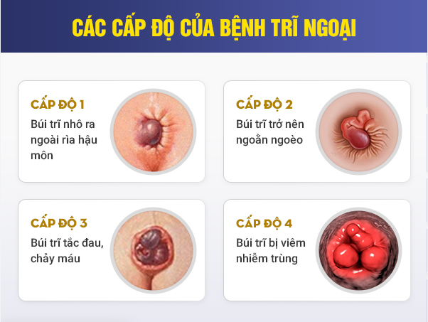 Giải đáp: Trĩ ngoại cấp độ 2 có nguy hiểm không?