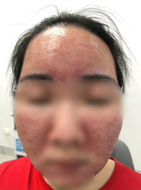 Nữ sinh cháy da vì tin lời quảng cáo kem "siêu chống nắng" giá rẻ trên mạng