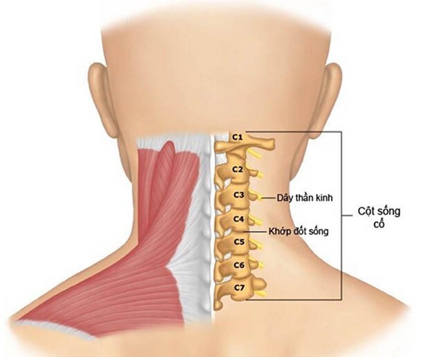 Vôi hóa đốt sống cổ là gì? Điều trị như thế nào?