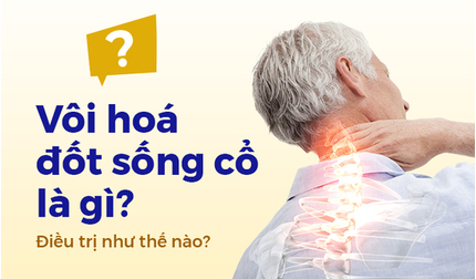Vôi hóa đốt sống cổ là gì? Điều trị như thế nào?