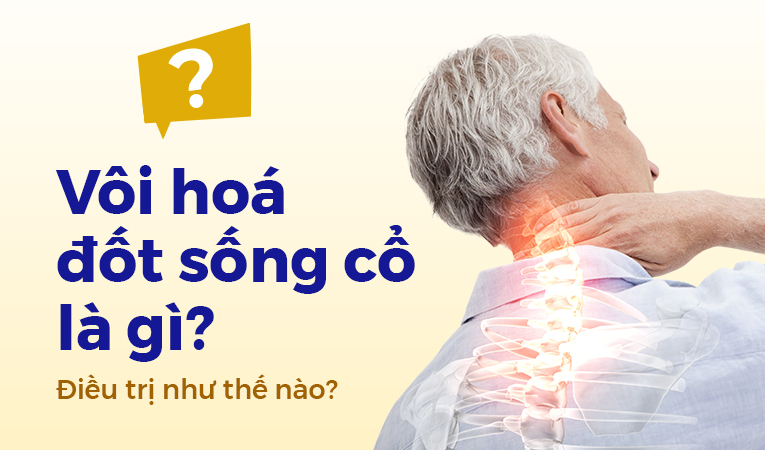 Vôi hóa đốt sống cổ là gì? Điều trị như thế nào?