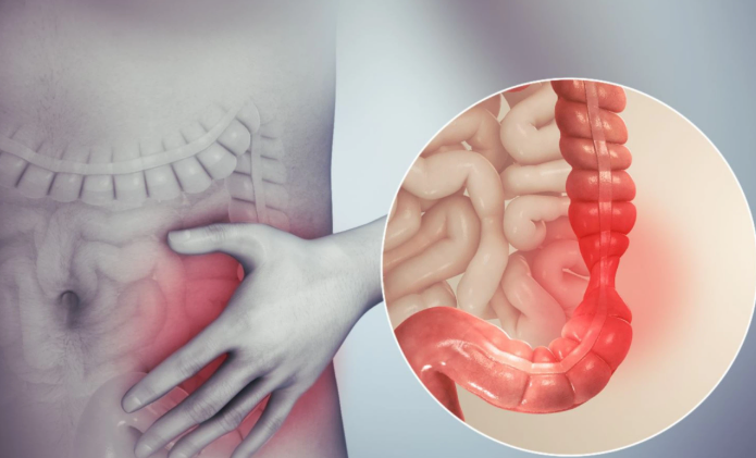 Viêm đại tràng co thắt tái đi tái lại Giải pháp nào hiệu quả lâu dài