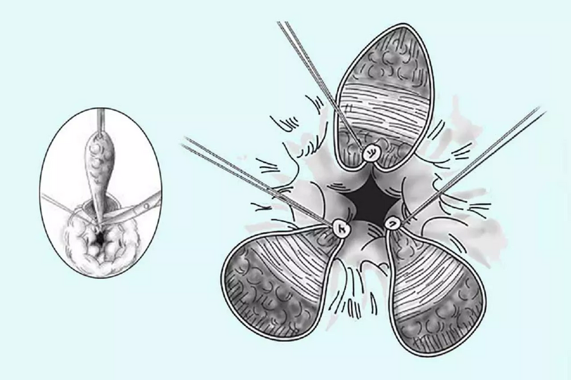 Bệnh trĩ hỗn hợp là gì? Điều trị như thế nào?