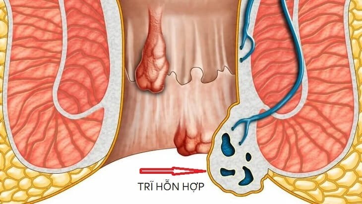 Bệnh trĩ hỗn hợp là gì? Điều trị như thế nào?
