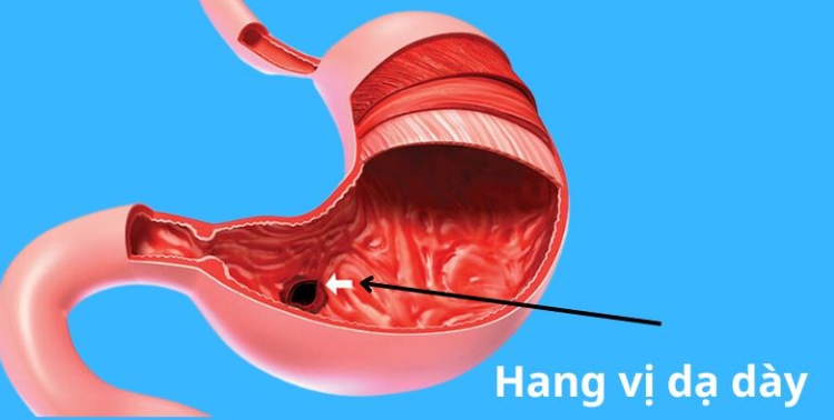 Đau dạ dày sau khi ăn: Có phải dấu hiệu nguy hiểm, cần điều trị?