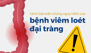 Cảnh báo biến chứng nguy hiểm của bệnh viêm loét đại tràng