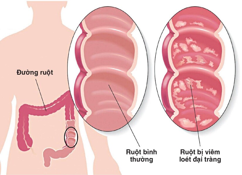 Cảnh báo biến chứng nguy hiểm của bệnh viêm loét đại tràng