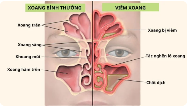 Cẩn trọng khi lạm dụng kháng sinh điều trị viêm mũi xoang