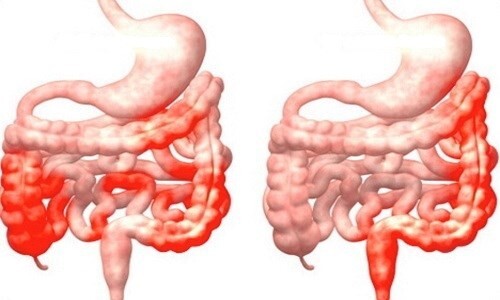 Giải đáp thắc mắc: Viêm đại tràng có khỏi được không?