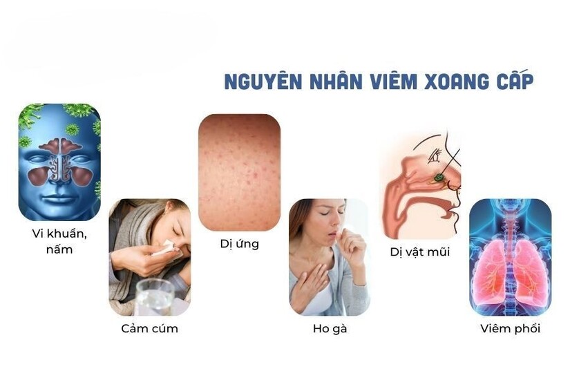 Nhận biết sớm các dấu hiệu viêm mũi xoang đợt cấp