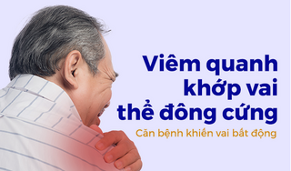 Viêm quanh khớp vai thể đông cứng – Căn bệnh khiến vai bất động