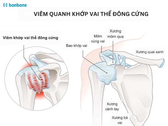 Viêm quanh khớp vai thể đông cứng – Căn bệnh khiến vai bất động