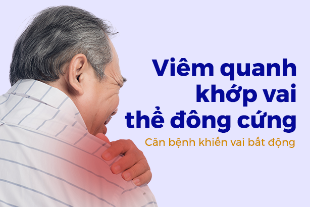 Viêm quanh khớp vai thể đông cứng – Căn bệnh khiến vai bất động