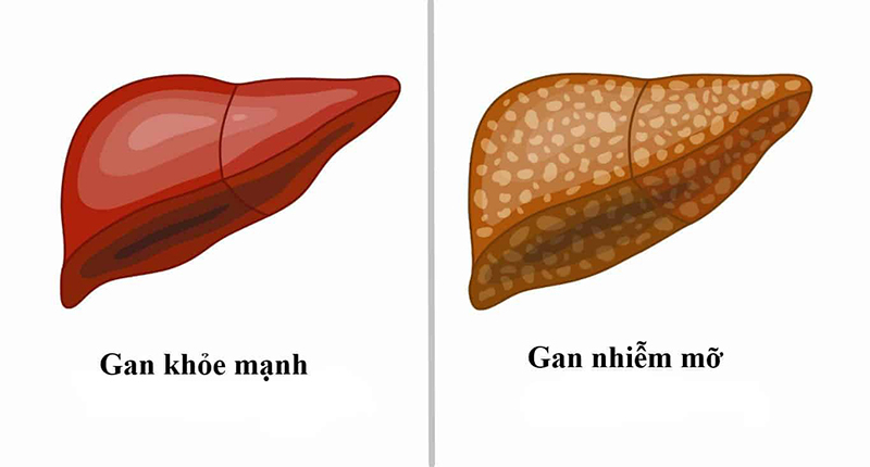 Gan nhiễm mỡ nhẹ: Dấu hiệu nhận biết và cách bảo vệ gan