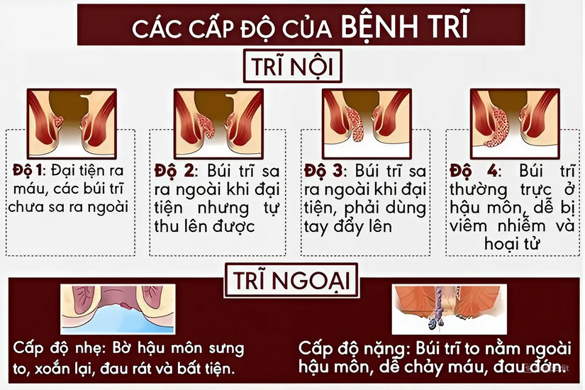 Điều trị bệnh trĩ: Khi nào cần phẫu thuật?