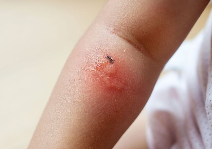 Gợi ý cho mẹ: 5 cách làm dịu da bé khi bị muỗi đốt