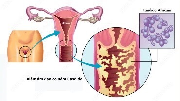 Dấu hiệu nhận biết viêm âm đạo do nấm ngứa Candida