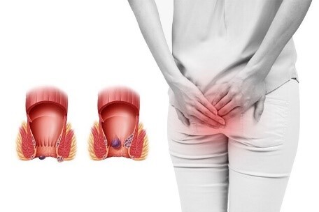 Tư vấn: Trĩ độ 3 uống thuốc có khỏi không?