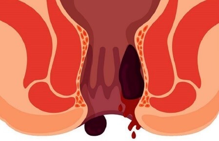 Tư vấn: Trĩ độ 3 uống thuốc có khỏi không?