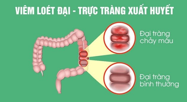 Viêm loét đại trực tràng chảy máu có nguy hiểm không? 