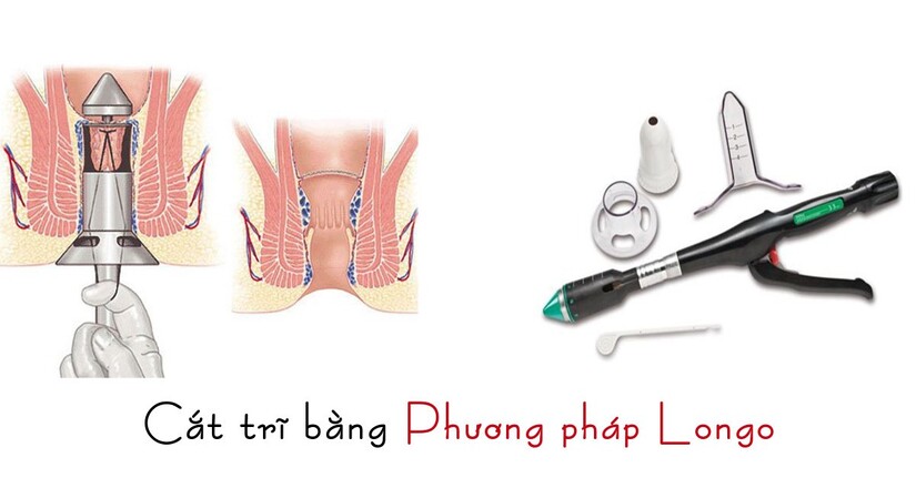 Giải đáp: Bệnh trĩ thường gặp ở độ tuổi nào?