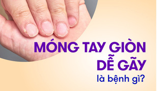 Móng tay giòn dễ gãy là bệnh gì, thiếu chất gì? 