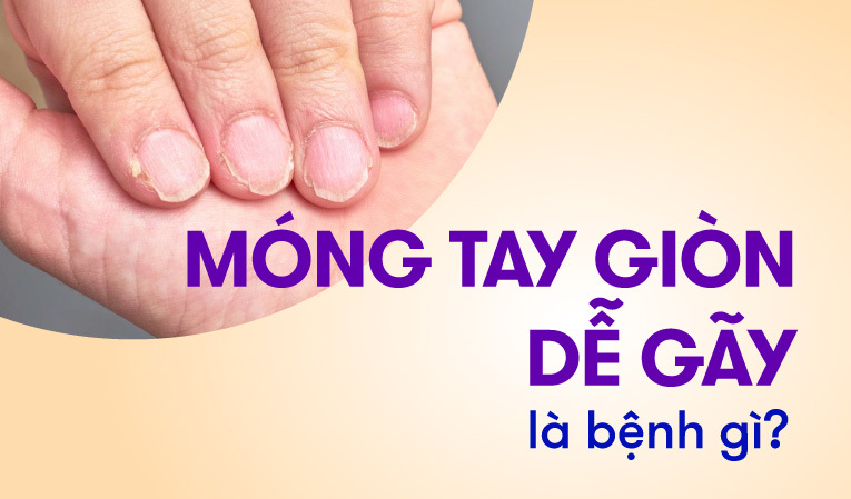 Móng tay giòn dễ gãy là bệnh gì, thiếu chất gì? 