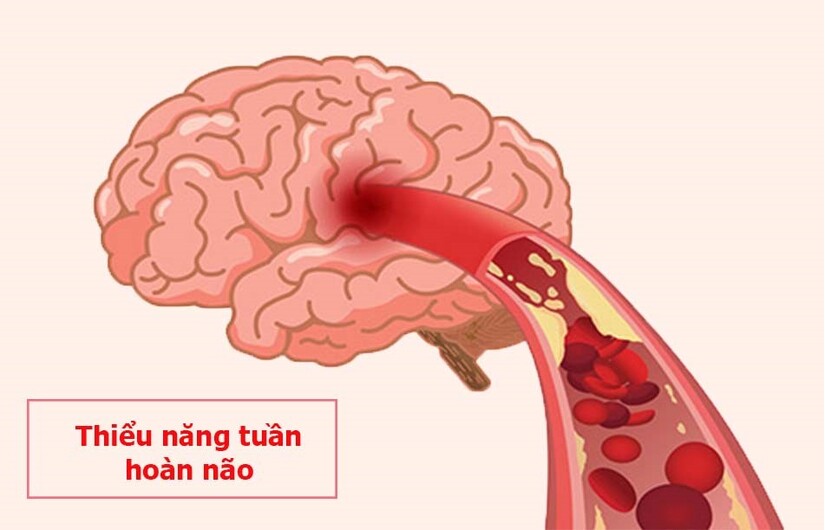 Thiểu năng tuần hoàn máu và mối liên hệ với mất ngủ, suy giảm trí nhớ