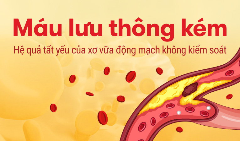 Máu lưu thông kém Hệ quả tất yếu của xơ vữa động mạch không kiểm soát