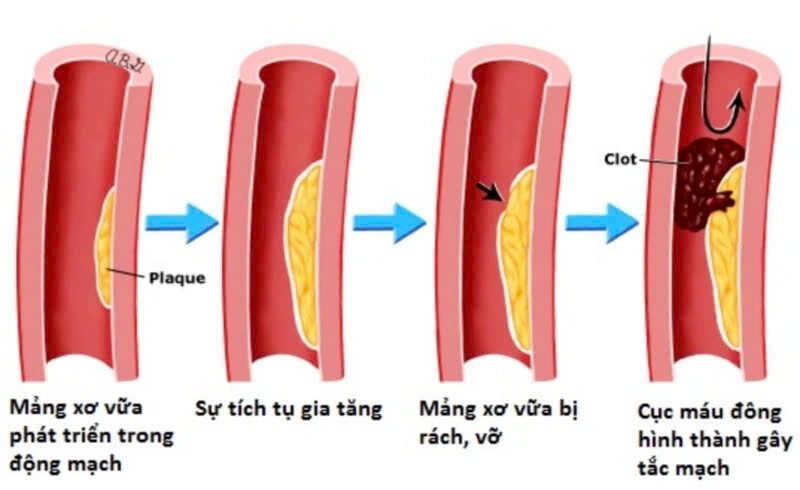 Máu lưu thông kém Hệ quả tất yếu của xơ vữa động mạch không kiểm soát