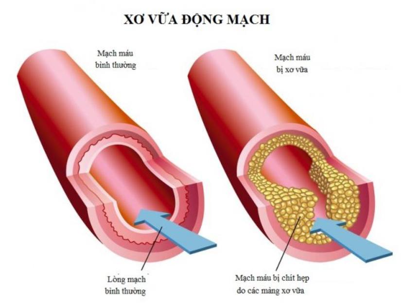 Máu lưu thông kém Hệ quả tất yếu của xơ vữa động mạch không kiểm soát