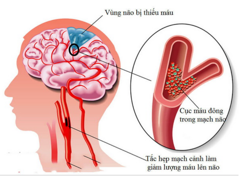 Tại sao máu lưu thông không tốt gây đau đầu mất ngủ tê bì tay chân