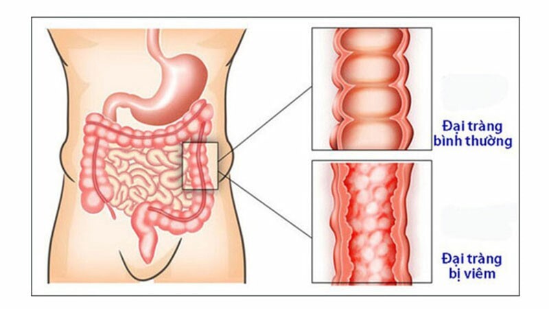 Khác biệt giữa đau bụng do viêm dạ dày và viêm đại tràng Đừng nhầm