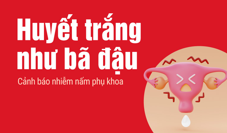 Huyết trắng vón cục như bã đậu: Cảnh báo nhiễm nấm phụ khoa