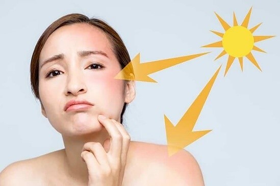 5 nguyên nhân khiến da bóng dầu hơn vào mùa hè