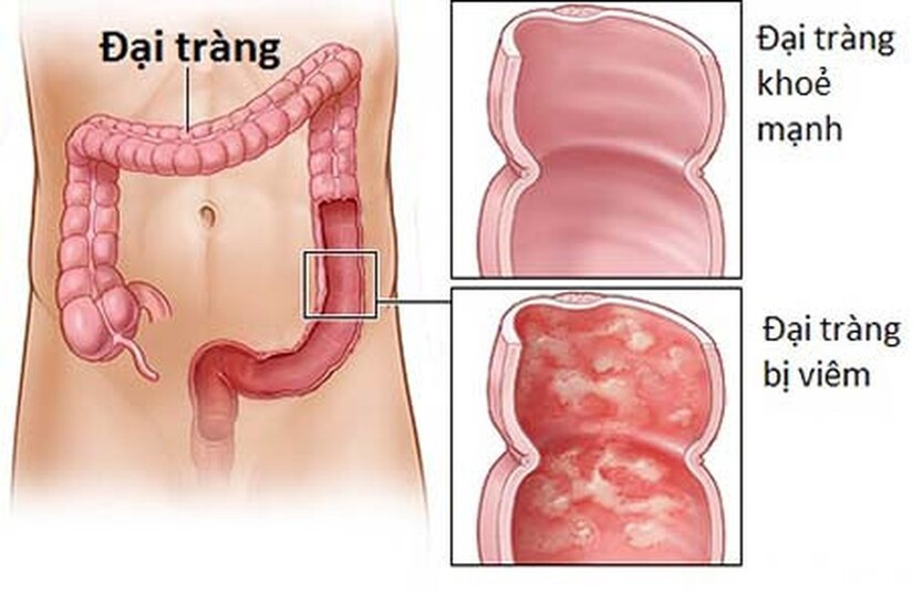 Bụng đầy hơi, sôi bụng sau ăn Là do bệnh đại tràng không phải dạ dày