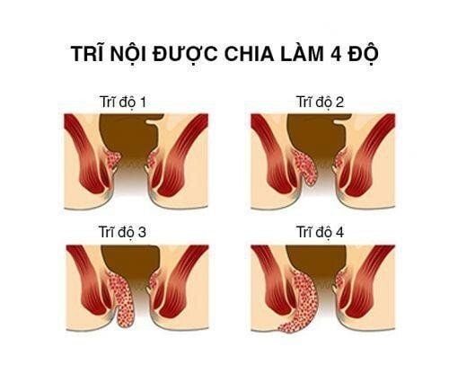 Trĩ nội độ 2 có nguy hiểm không? Nguyên nhân và cách khắc phục 