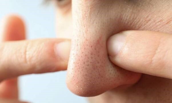 Có nên tự nặn mụn đầu đen ở mũi: Câu trả lời khoa học cần biết