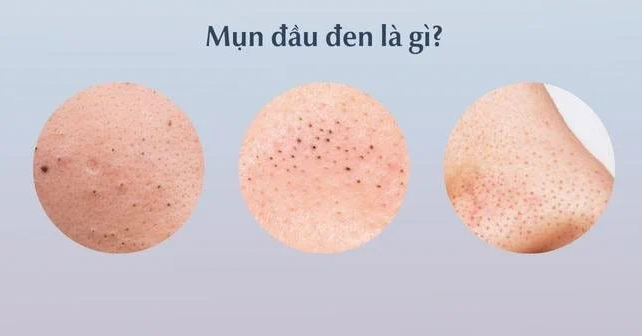 Có nên tự nặn mụn đầu đen ở mũi: Câu trả lời khoa học cần biết