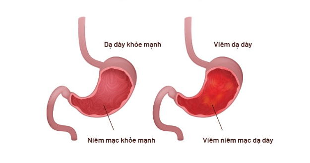 Tại sao thuốc dạ dày từ dược liệu lại phù hợp với người bệnh mạn tính