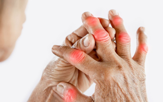 Cứng khớp buổi sáng – Triệu chứng đặc trưng của viêm khớp dạng thấp