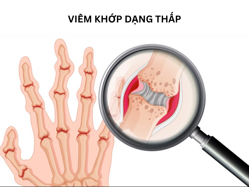 Cứng khớp buổi sáng – Triệu chứng đặc trưng của viêm khớp dạng thấp