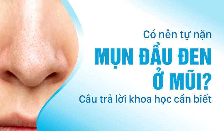 Có nên tự nặn mụn đầu đen ở mũi: Câu trả lời khoa học cần biết