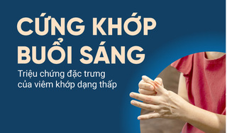 Cứng khớp buổi sáng – Triệu chứng đặc trưng của viêm khớp dạng thấp
