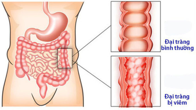 Viêm đại tràng không điều trị sớm – Nguy cơ biến chứng nguy hiểm