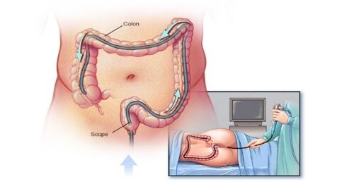 Giải đáp: Co thắt đại tràng có nguy hiểm không?
