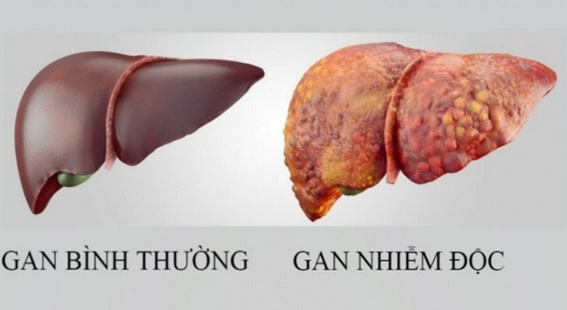 Vì sao nên chọn giải độc gan từ thảo dược tự nhiên?