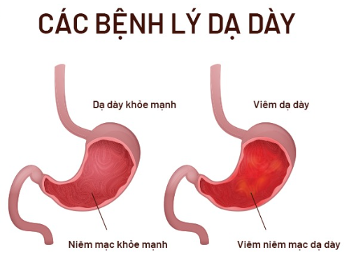 Tại sao nên uống thuốc dạ dày vào lúc đói để đạt hiệu quả tối ưu?