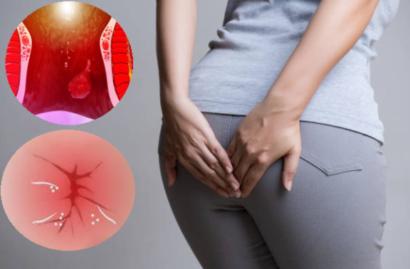 Bệnh trĩ ngứa hậu môn: Vì sao càng gãi càng ngứa?