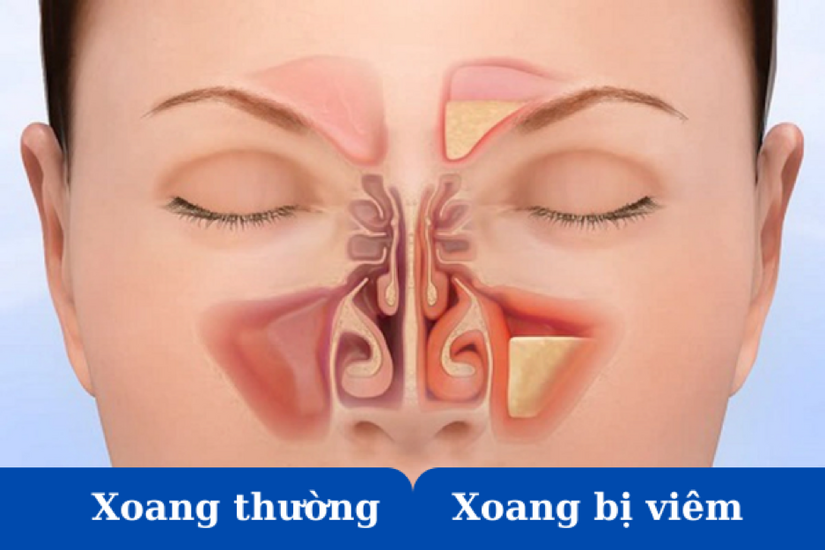 Phân biệt triệu chứng viêm xoang và cảm cúm tránh nhầm lẫn nguy hiểm